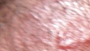 ¿Adiós a la psoriasis? Nuevo fármaco elimina en casi su totalidad esta afección de la piel