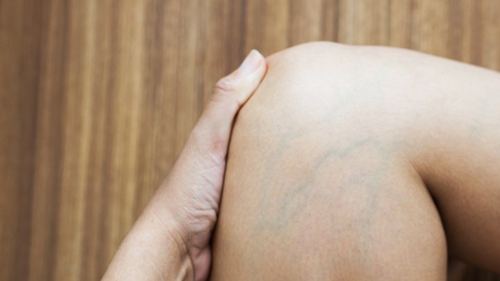 venas varicosas, váricen, dolor de piernas