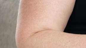 cancer de colon riesgo hábitos