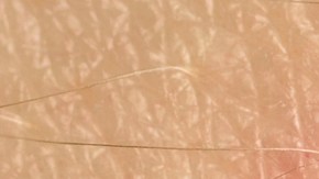 enfermedad de lyme, síntomas