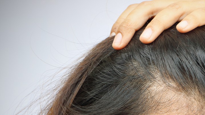 COVID prolongado alopecia libido