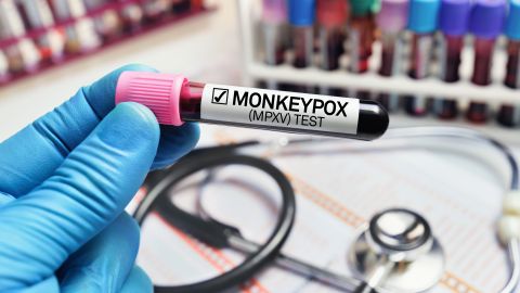 Los estados de EE.UU. con más infecciones por viruela del mono
