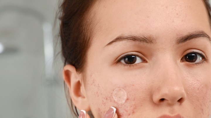 acné podría estar empeorando