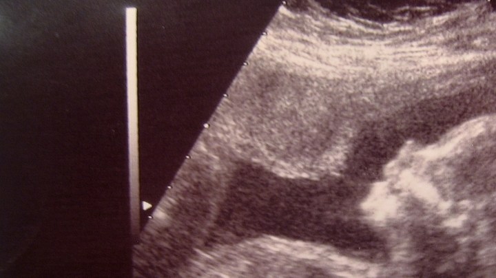 calcomanía de ultrasonido