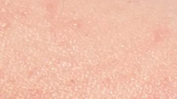 Nuevo síntomas de viruela del mono