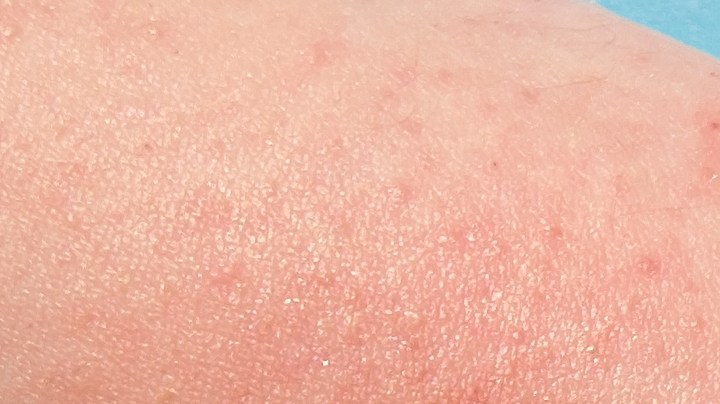 Nuevo síntomas de viruela del mono