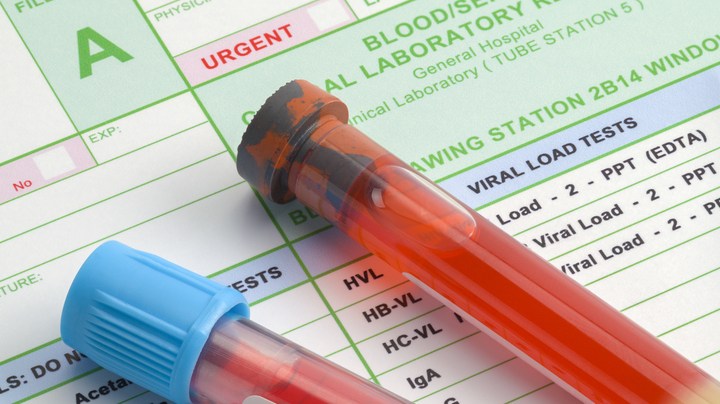 Derrame cerebral sangre tipo A