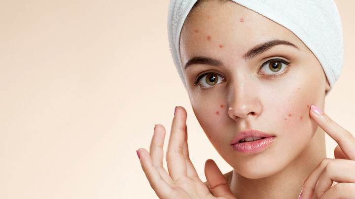 Cuando se trata de la frente, la nariz, o zona T, y las mejillas normalmente son brotes por el aumento de sebo, una dieta alta en azúcar y/o estrés.