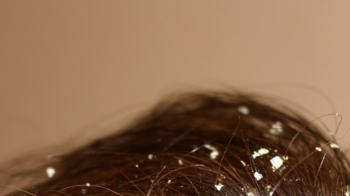 Caspa cosas que la empeoran