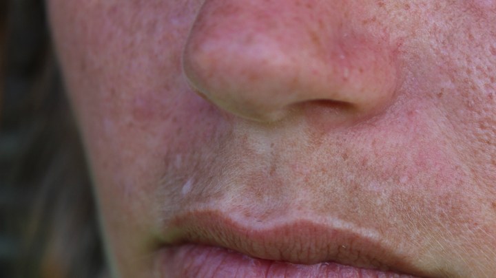 Por qué se mancha el área del bigote