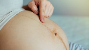 Por qué aparece una línea negra en la barriga durante el embarazo
