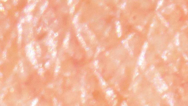 me mordió una garrapata