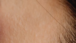 Acupuntura de la oreja bajar de peso