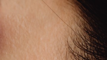 Acupuntura de la oreja bajar de peso