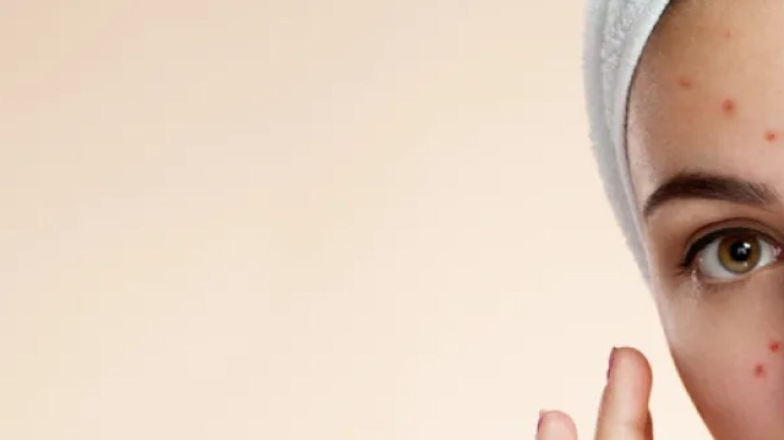 Por qué no debes reventarte los granos de la nariz.