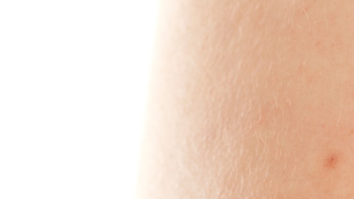 Cómo eliminar el acné en los glúteos.