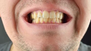 Razones sorprendentes por las que tienes dientes amarillos.