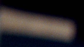 Cirugía de orejas: una de las principales operaciones estéticas en EE.UU.