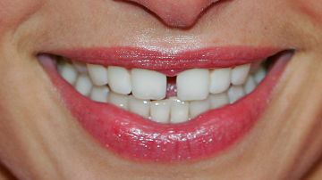 Tus emociones desarrollan trastornos dentales, según la odontología holística