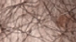 Qué es la hipertrofia benigna de próstata y cuándo es peligrosa