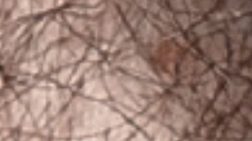 Qué es la hipertrofia benigna de próstata y cuándo es peligrosa