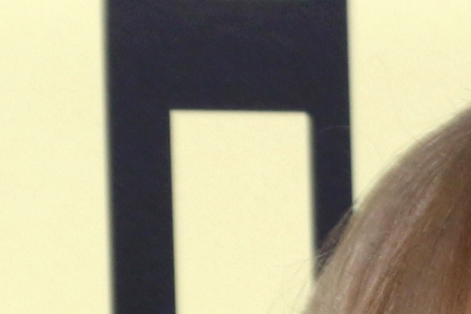 Síndrome de Cushing: de qué trata la enfermedad de la actriz Amy Schumer