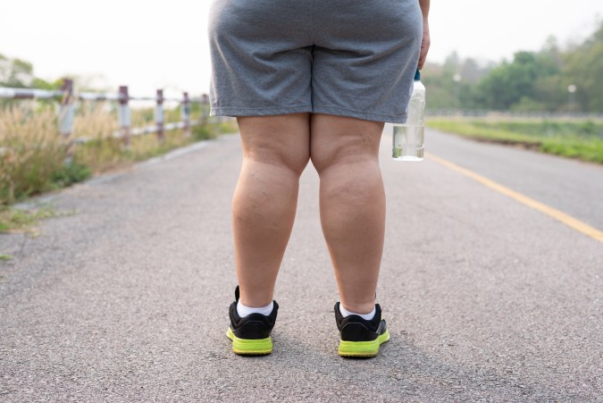 Lipedema: La enfermedad que se confunde con obesidad, pero no tiene cura