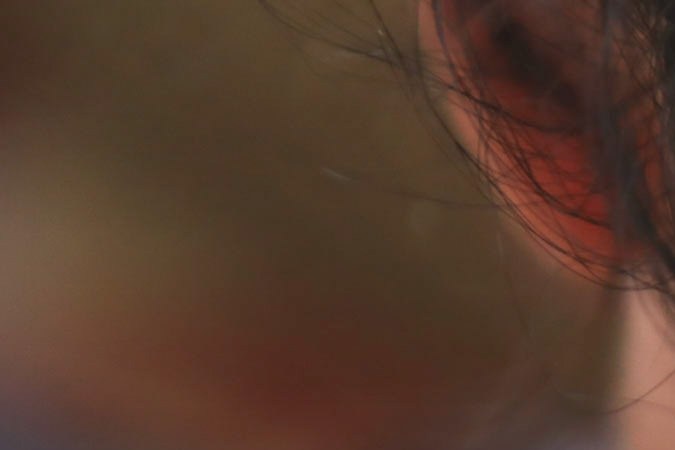 El lupus puede estar dormido años, pero es una enfermedad para toda la vida