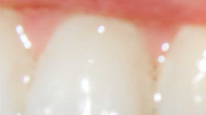 Las caries aparecen cuando has permitido que ciertas bacterias ingresen a tu boca y causen daños que dejan manchas y heridas.