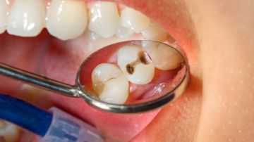 Las caries aparecen cuando has permitido que ciertas bacterias ingresen a tu boca y causen daños que dejan manchas y heridas.