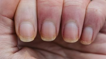 La alimentación rica en vitamina E y el cuidado diario de tus uñas ayuda a evitar ese aspecto amarillo.