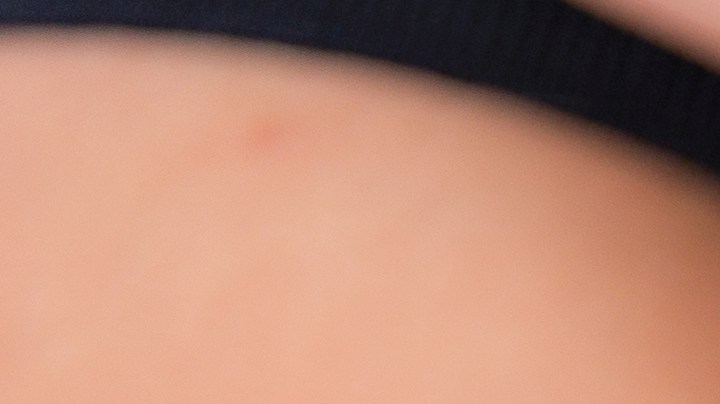 Por seguridad, cualquier mordedura de serpiente debe considerarse venenosa y solo puede ser tratada por especialistas.