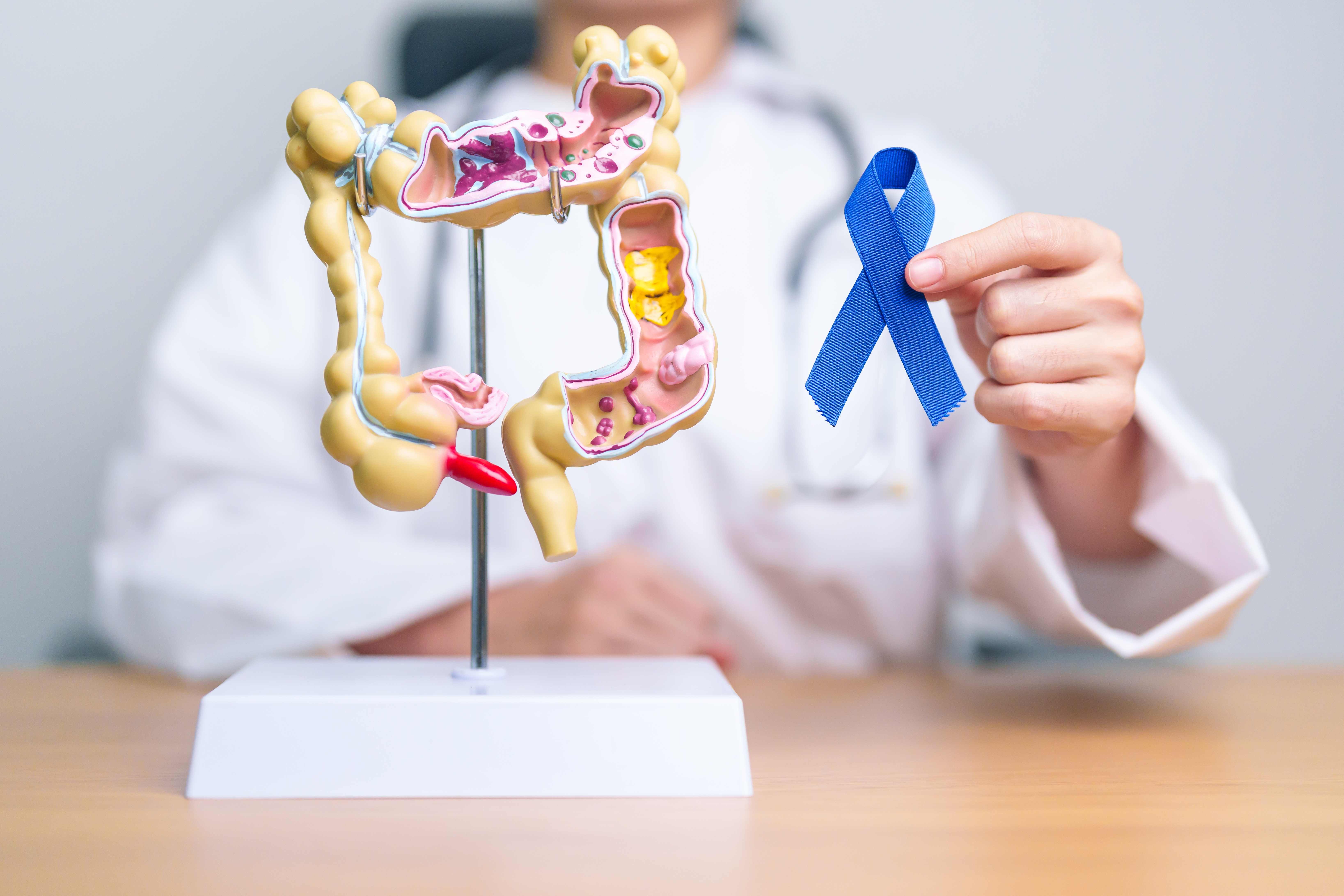 El cáncer de colon tiende a estar provocado principalmente por factores hereditarios.