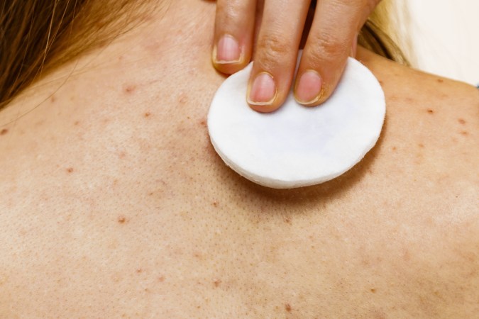 Acude con un especialista para que determine el tratamiento adecuado para tu acné.