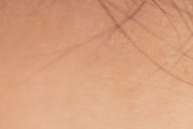 El Dermapen puede tratar arrugas y líneas de expresión en zonas específicas.