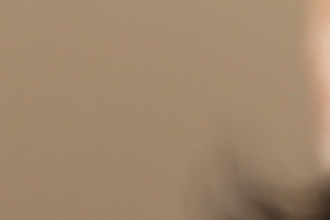 Un dermatólogo puede determinar el motivo por el que aparecen brotes de acné.