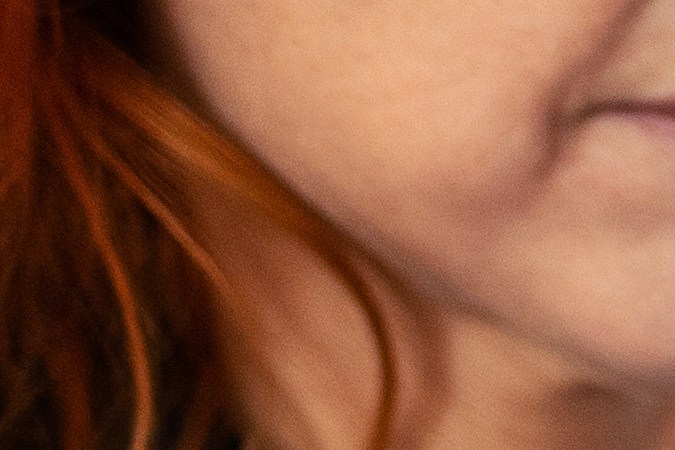 El láser capilar debe ser aplicado por un especialista.