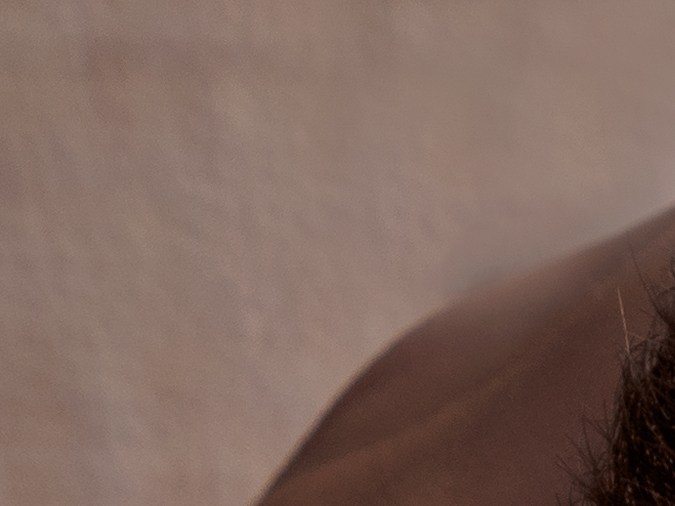 La alopecia androgénica en hombres se refleja en la caída de la línea del cabello. 