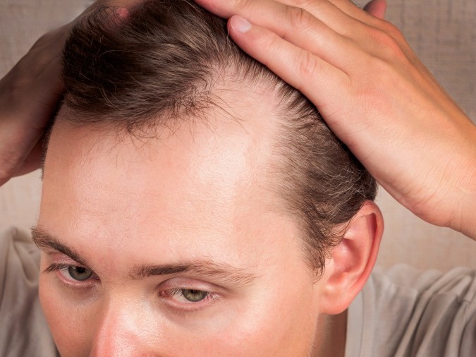 La alopecia androgénica en hombres se refleja en la caída de la línea del cabello.