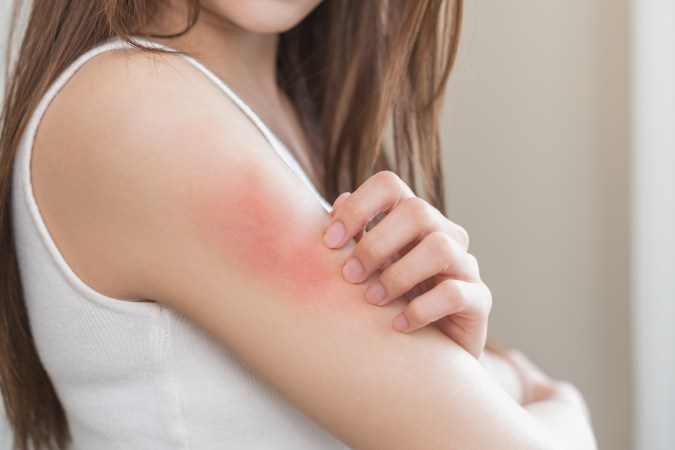 El alcohol puede aumentar el enrojecimiento e diferentes zonas del cuerpo.