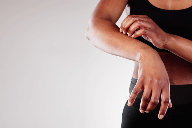 El eczema puede generar manchas oscuras en la piel afroamericana.