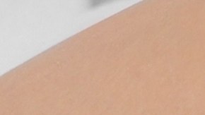 varices
