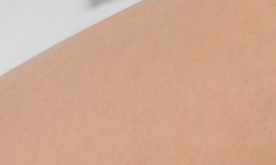 varices