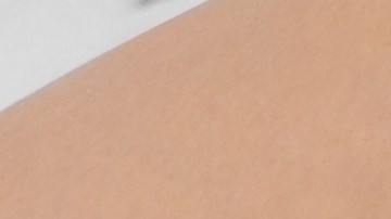 varices