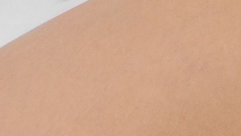 varices