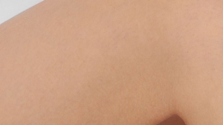 varices